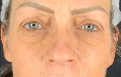 chemical peel after
