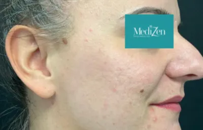 Microneedling treatment after