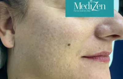 Microneedling treatment before