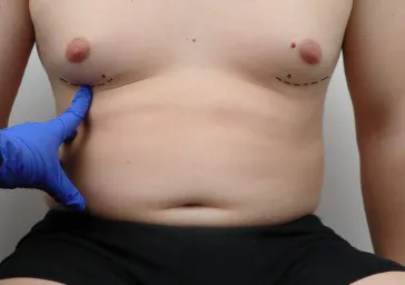 Gynaecomastia ( Man Boobs or Moobs )