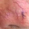 Thread Veins or Spider Veins