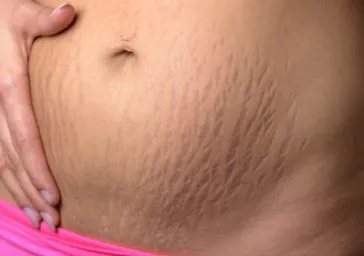 Stretch Marks ( Striae )