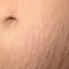 Stretch Marks ( Striae )