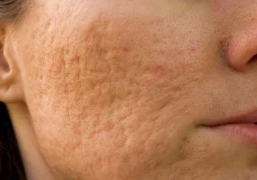 Scarring ( Acne, Keloid, Atrophic Scars )