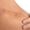 Scarring ( Acne, Keloid, Atrophic Scars )