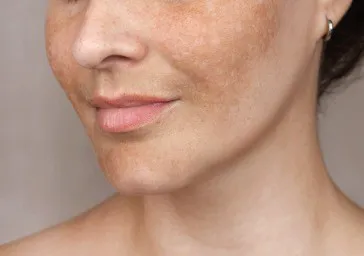 Pigmentation ( Age Spots, Brown Spots )