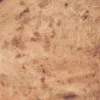 Pigmentation ( Age Spots, Brown Spots )