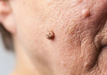 Moles, Warts, Skin Tags and Benign Growths