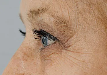 Eyes - Bags and Crow’s Feet