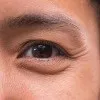 Eyes - Bags and Crow’s Feet