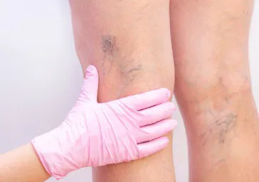 Varicose Veins Varicose Veins