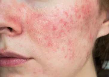 Rosacea