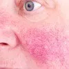 Rosacea