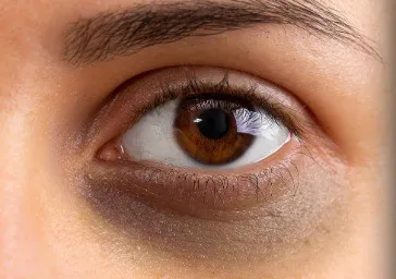 Eyes - Tear Trough ( Dark Circles )