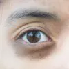 Eyes - Tear Trough ( Dark Circles )