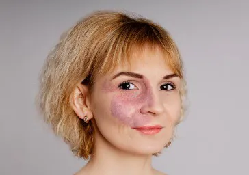 Vascular Abnormalities ( Angiomas, Port Wine Stains )