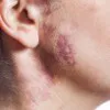 Vascular Abnormalities ( Angiomas, Port Wine Stains )