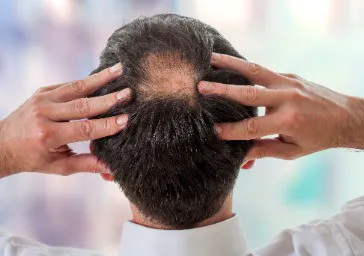 Hair Loss ( Male Pattern Baldness, Alopecia )