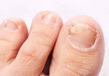 Fungal Nail Infection ( Onychomycosis )
