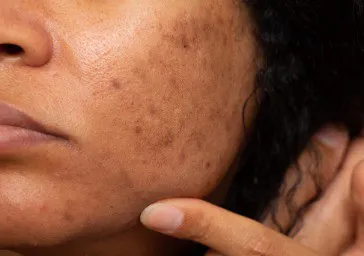 Melasma (Chloasma)