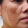 Melasma (Chloasma)