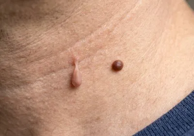 From Other Skin Growths Image