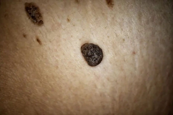 How Skin Of Colour Heals Differently 