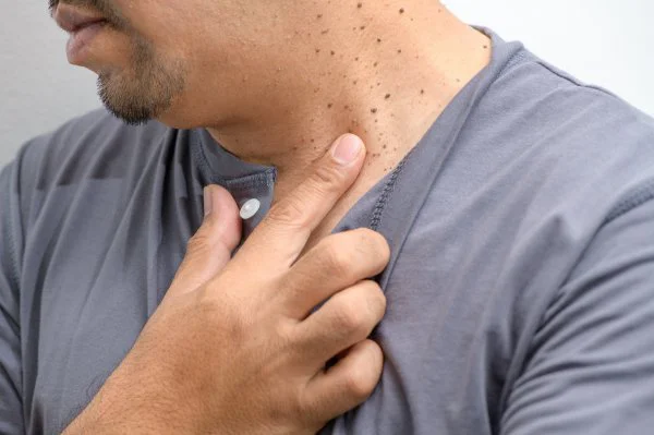 Skin Tags Are Dangerous Or Cancerous
