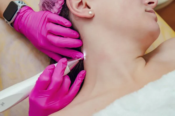 Professional Skin Tag Removal Methods Explained
