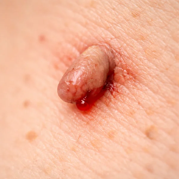 Skin tag bleeding