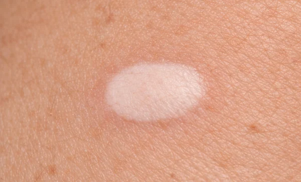 Skin tag Hyperpigmentation