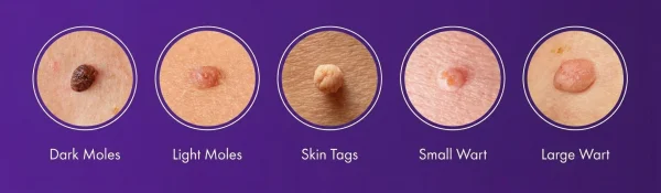 Skin Tags Vs Other Skin Growths