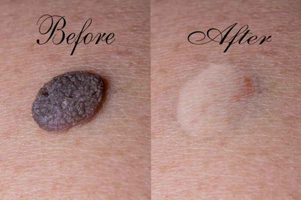 Skin Tag Removal Before And after