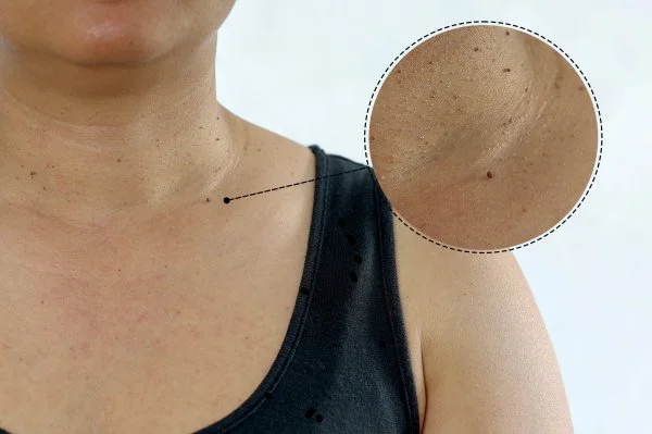 What Do Skin Tags Look And Feel Like?