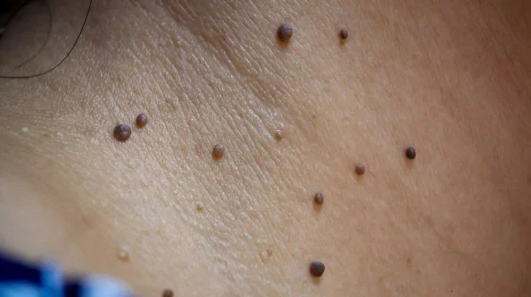 What Skin Tags Are And Why People Ask How They Develop