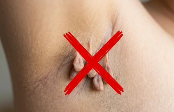 When Skin Tag Removal May Not Be Appropriate