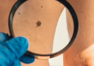 Skin Tag Removal