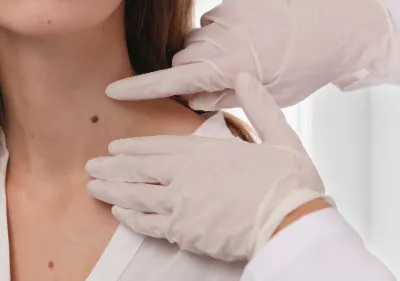 Skin Tags Develop? Image
