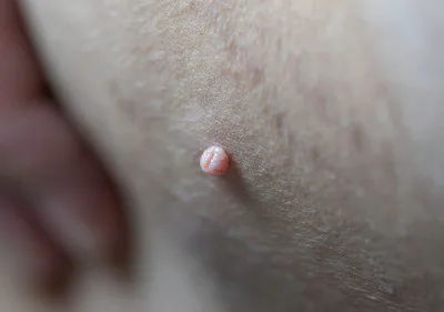 Skin Tags? Image