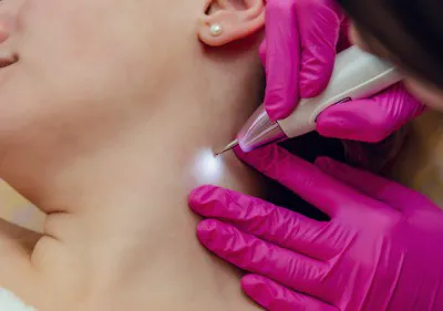 Skin Tag Removal Process Image