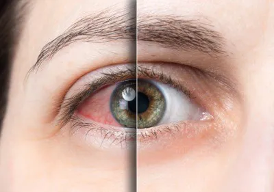 Dry Eye Disease? Image