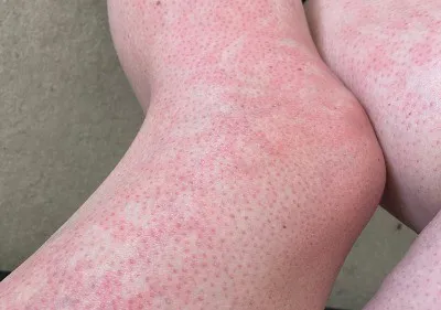 Toasted Skin Syndrome? Image