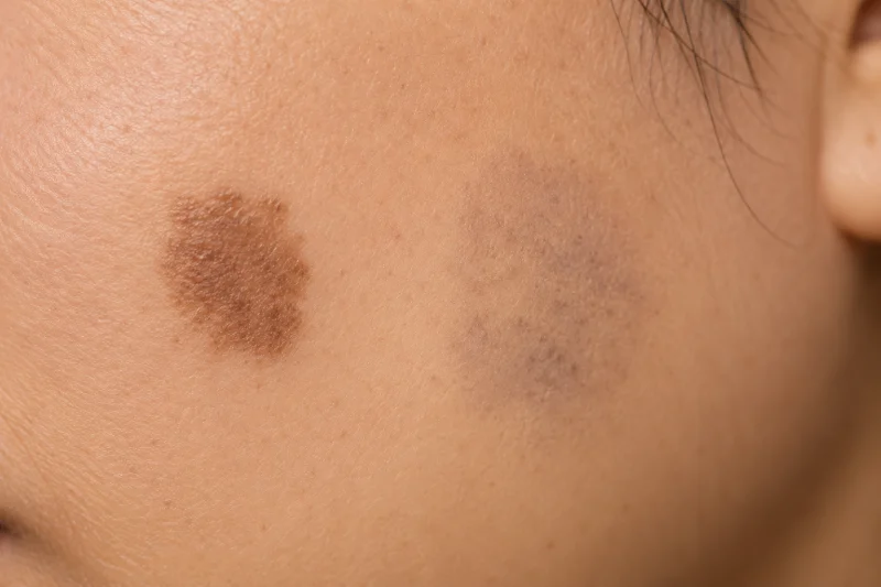 Close-up of skin with pigmentation spots
