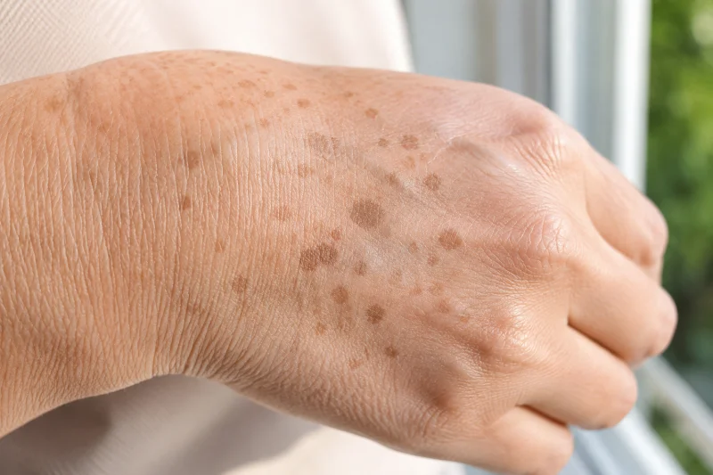 Sun spots and age spots