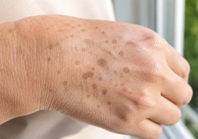 Hyperpigmentation Happen? Image