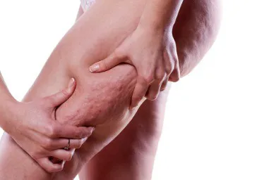 Cellulite