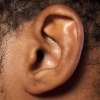Ear Correction, Ear Pinning