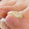 Fungal Nail Infection ( Onychomycosis )