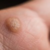 Moles, Warts, Skin Tags and Benign Growths