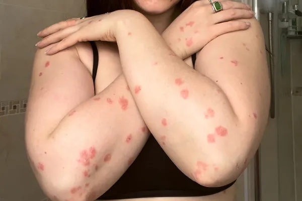 Skinflammation